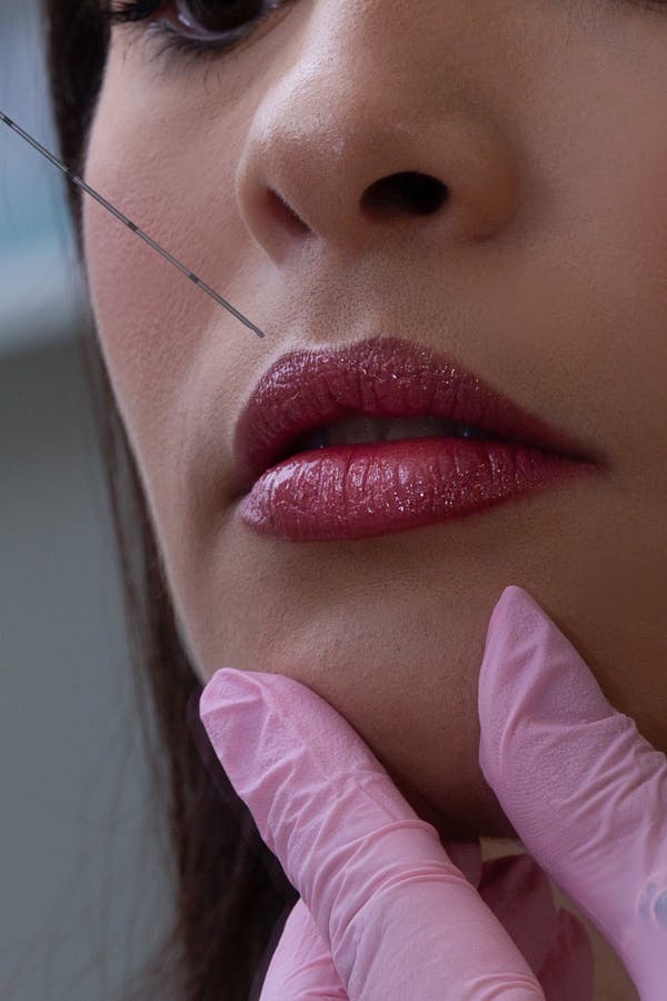 Lip filler injection being administered in clinic setting